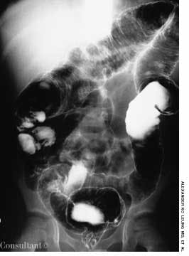Ulcerative Colitis in a Young Boy