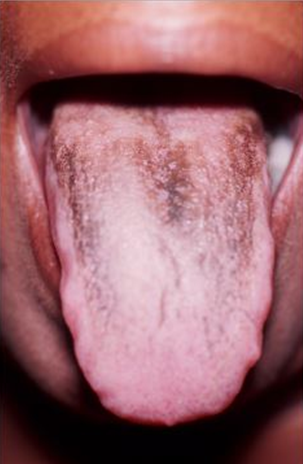 Black Coating on a Woman’s Tongue