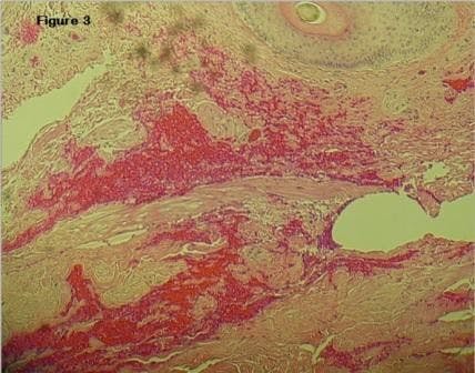 Scrotal Calcinosis in Normocalcemic Primary Hyperparathyroidism