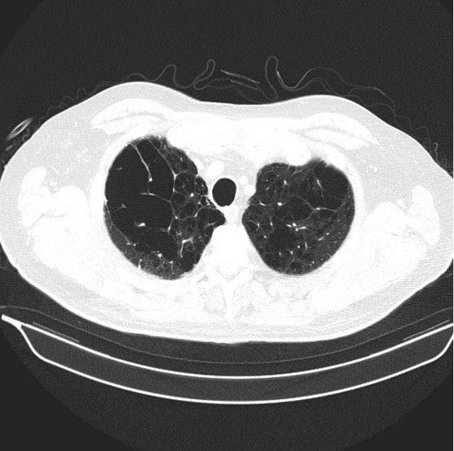 A Case of Worsening Dyspnea and Cough