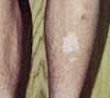 Vitiligo on Lower Extremities of a 14-Year-Old Boy
