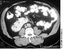 Crossed Renal Ectopia With Fusion