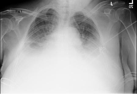 Re-expansion pulmonary edema