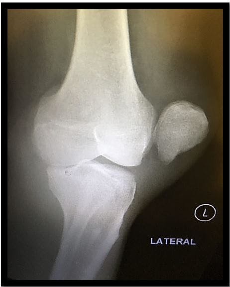 Knee Injury 