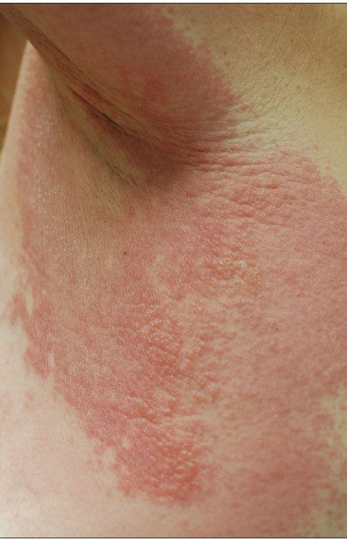Is this extensive rash a drug reaction-or something else?