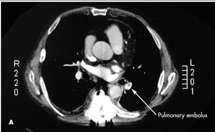 Arterial and Venous Thrombosis From a Patent Foramen Ovale (With Video)