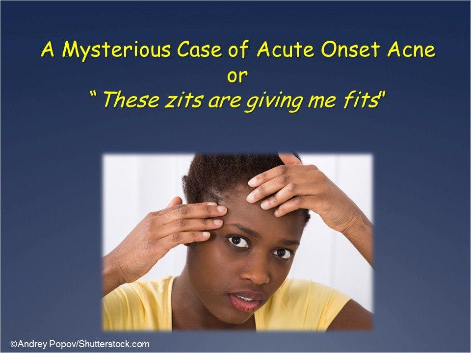 Acute-onset Acne: A Mysterious Case 