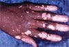 Vitiligo on Hands of a 33-Year-Old Man
