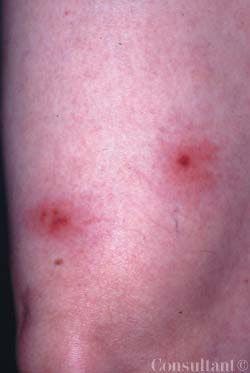 Atypical Herpes Zoster