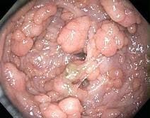 Thousands of Colorectal Polyps: Your Dx?