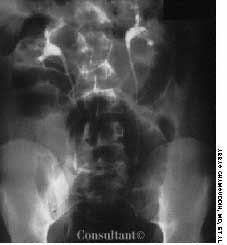 Cecal Volvulus at an Unusual Age