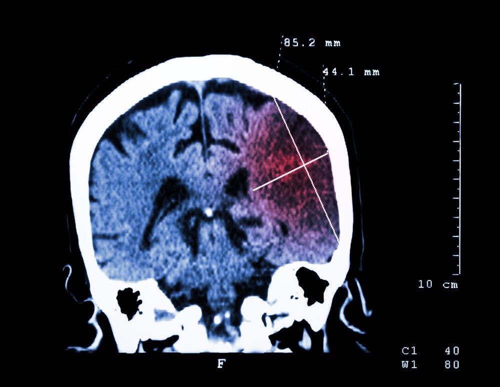 Risk of Stroke May Diminish with Age in Persons with Diabetes and Hypertension: New Findings