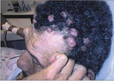 An Old Man With a Stroke and Multiple Bumps on His Head