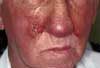 Angiosarcoma of the Face