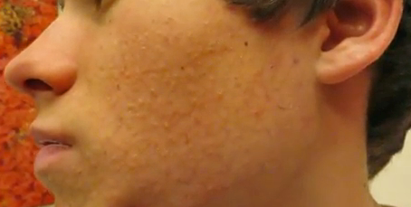 Teen With Itchy Papular Rash on Face and Arms