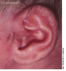 Accessory Tragus on Left Ear of an Infant