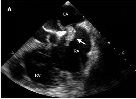 Spontaneous Embolization of a Thrombus-in-Transit