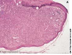 Bacillary Angiomatosis