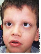 Cardiofaciocutaneous Syndrome in a 7-Year-Old Boy