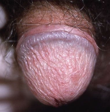 Does this scaling rash signal an underlying disorder?