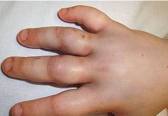 Swollen Hands-What’s Biting?