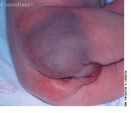 Acrocyanosis in a Female Newborn