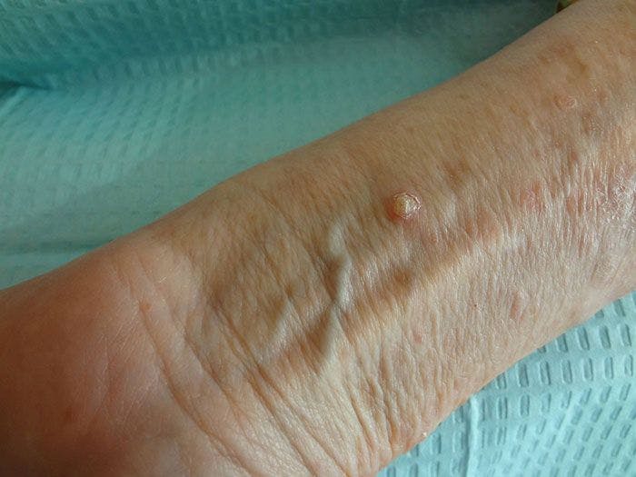 Another Non-Melanoma Skin Cancer?