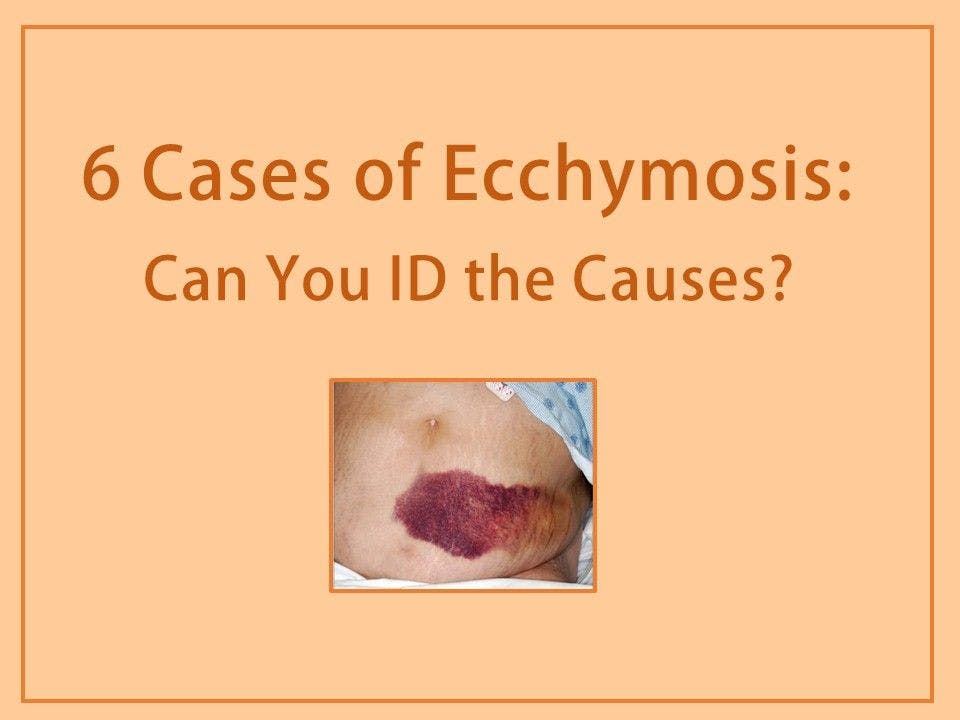 6 Cases of Ecchymosis: Can You ID the Causes? 