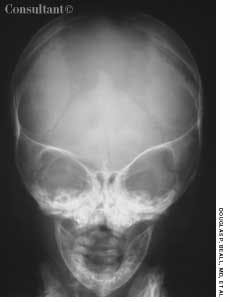 Cleidocranial Dysostosis in a 4-Month-Old Boy
