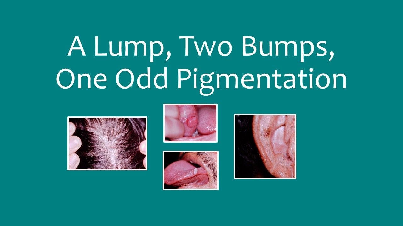 A Lump, Two Bumps, and One Odd Pigmentation