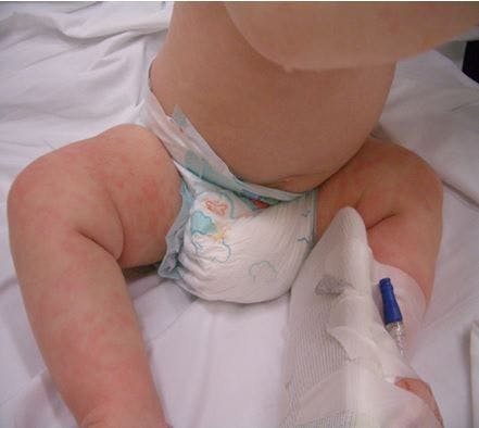Kawasaki disease in a 7-month-old boy 