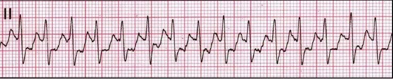 Palpitations in a Young Woman: What's in Your Differential?