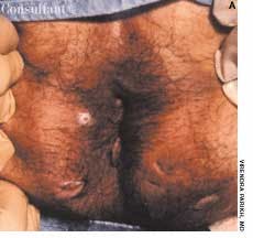 Complex Anorectal Fistula in a 45-Year-Old Man