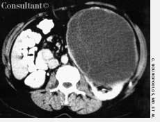 Wilms Tumor: A Rare Finding in an Adult 