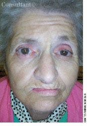 Bell's Palsy in a 75-Year-Old Woman