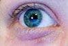 Contact Dermatitis on Eyelid