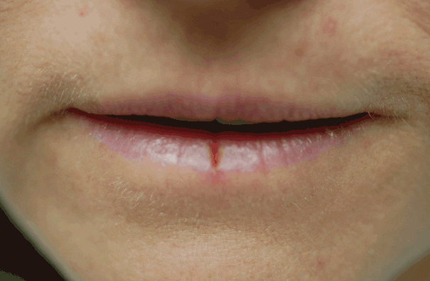 Why haven’t emollients healed this lip fissure?