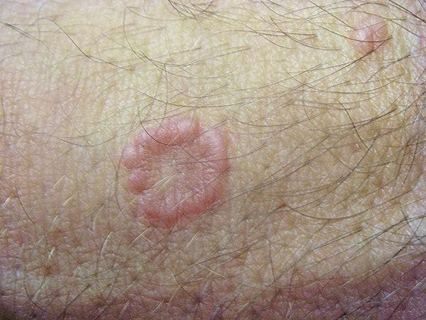 Rashes in Younger Patients: A Photo Quiz