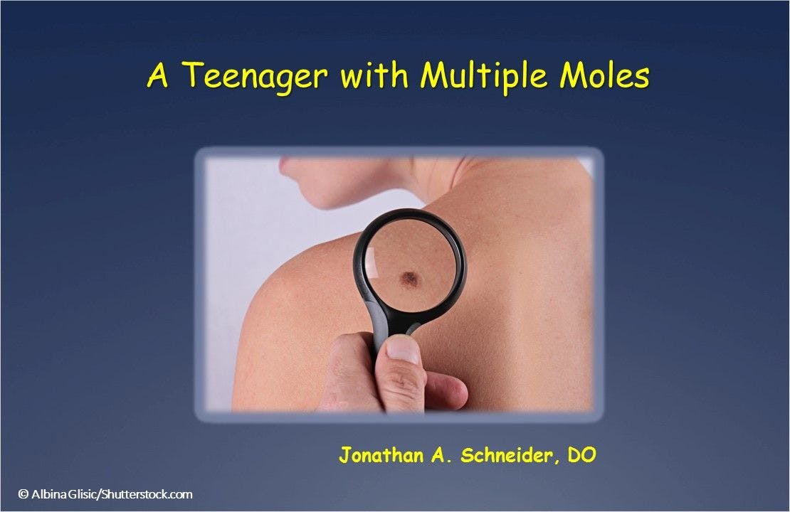 A Teenager with Multiple Moles 