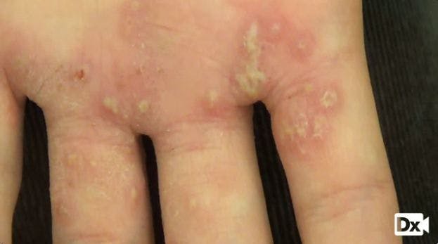 A 13-year-old Girl with a Vesicular Rash on Palms 