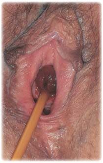 Middle-aged woman with angry red tissue at entrance of foley catheter
