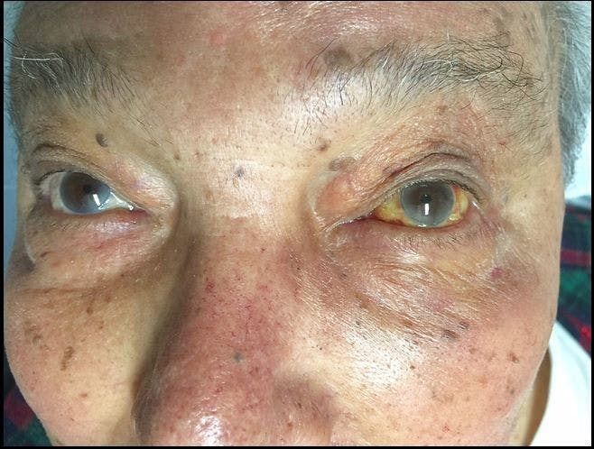 Unilateral Scleral Jaundice in an Elderly Man: An Odd Finding 