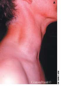 Papillary Carcinoma of the Thyroid