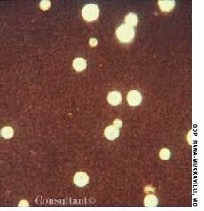 Cryptococcus neoformans Infection