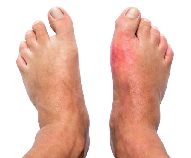 Allopurinol May Help Prevent First ACS Event in Patients with Gout