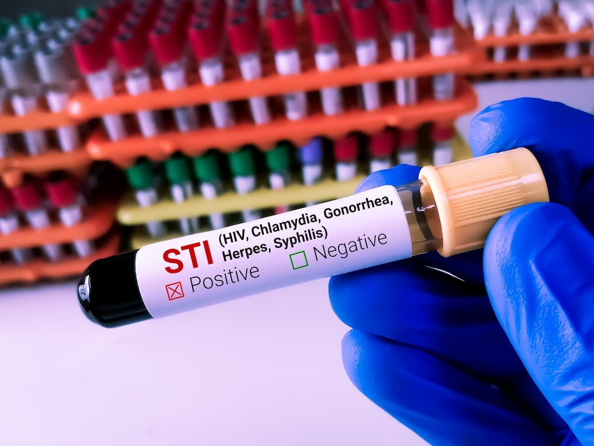 CDC: Gonorrhea Cases Declined for First Time in Decade, but Syphilis Keeps Climbing / Image credit: ©Saiful52/AdobeStock