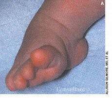 Congenital Clubfoot