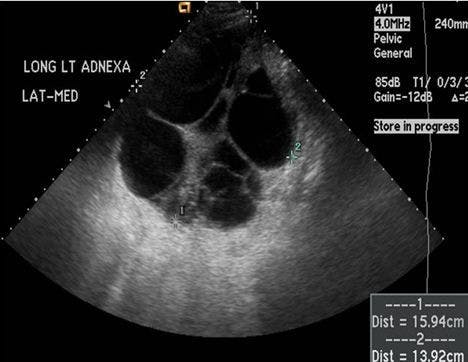 Constant Dull Abdominal Pain in a 35-year-old Woman