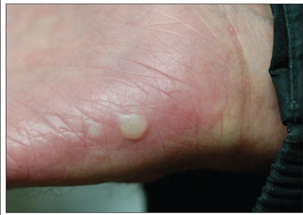 What caused these highly pruritic blisters?
