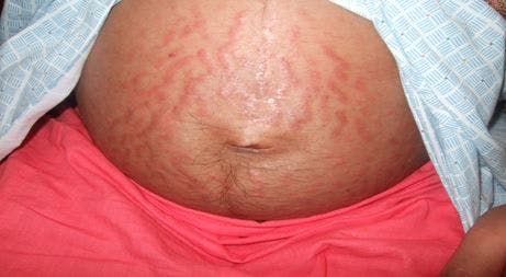 Pruritic urticarial papules and plaques of pregnancy 